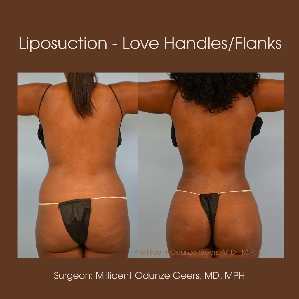 Best Colorado Springs Liposuction of Love Handles, Flanks, Back