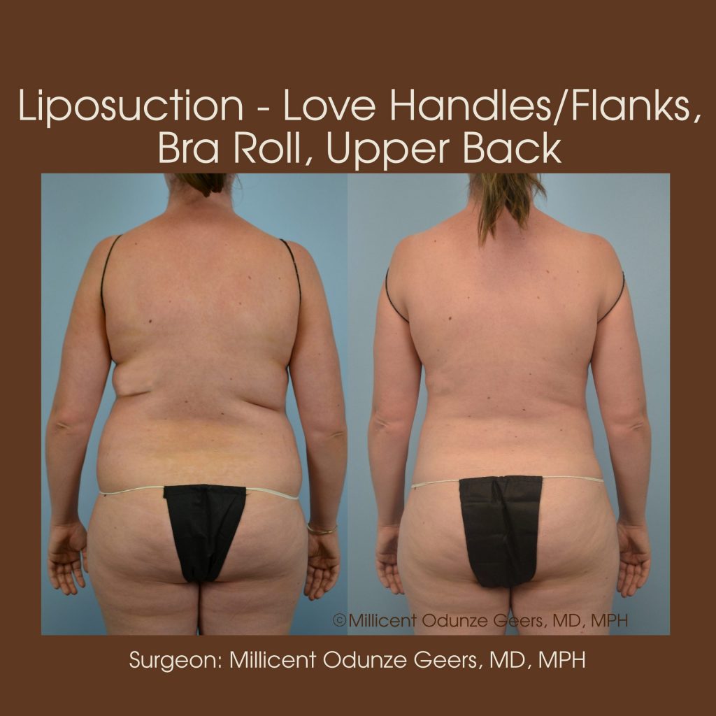 Best Colorado Springs Liposuction of Love Handles, Flanks, Bra Roll, Upper Back