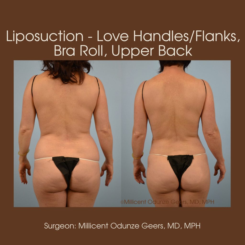 Best Colorado Springs Liposuction of Love Handles, Flanks, Bra Roll, Upper Back