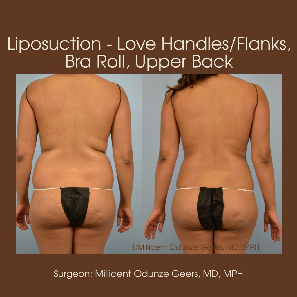 Best Colorado Springs Liposuction of Love Handles, Flanks, Bra Roll, Upper Back