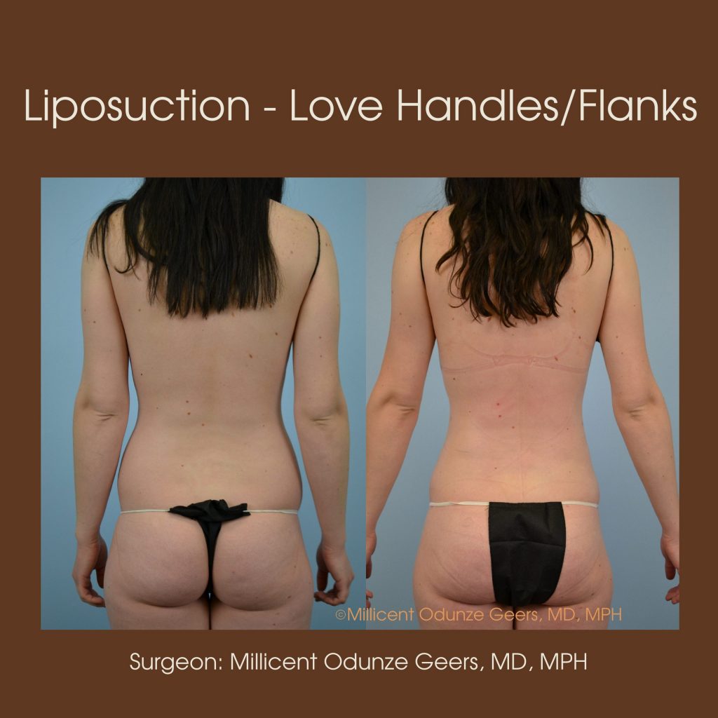 Best Colorado Springs Liposuction of Love Handles, Flanks, Back