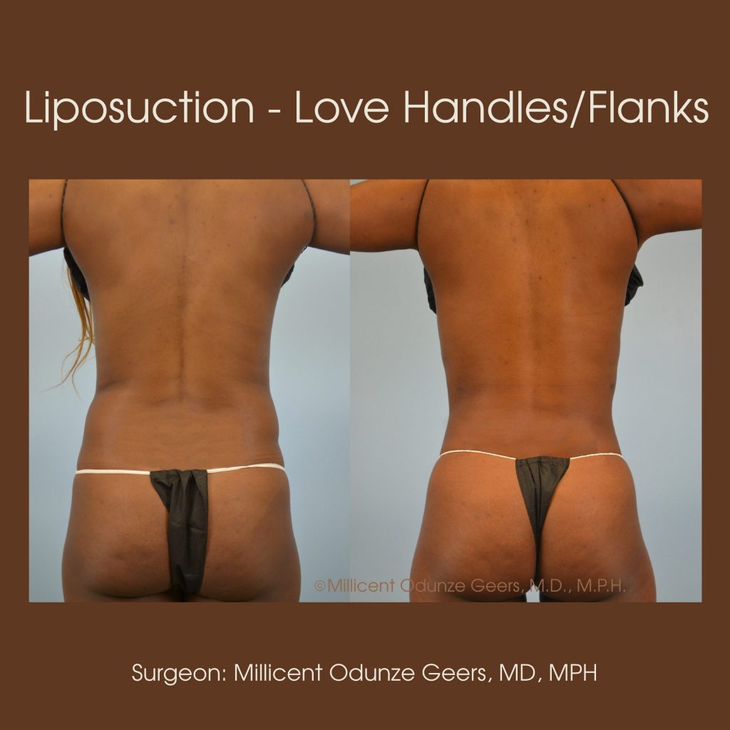 Best Colorado Springs Liposuction of Love Handles, Flanks, Back