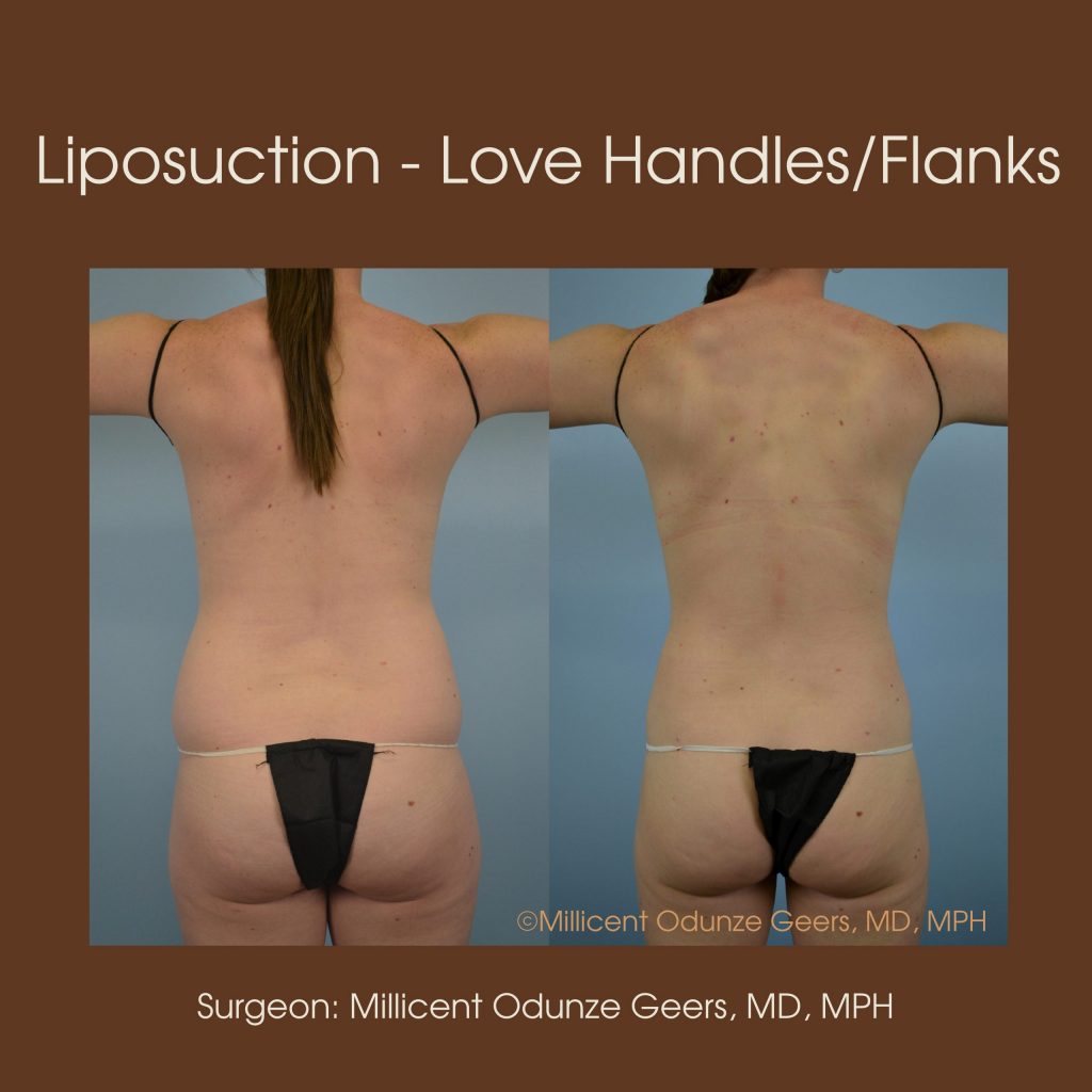 Best Colorado Springs Liposuction of Love Handles, Flanks, Back