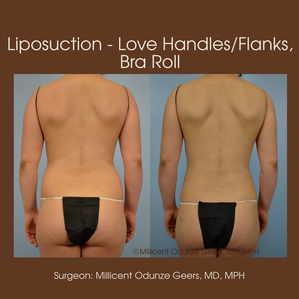 Best Colorado Springs Liposuction of Love Handles, Flanks, Back, Bra Roll