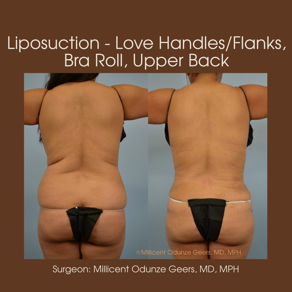 Best Colorado Springs Liposuction of Love Handles, Flanks, Bra Roll, Upper Back