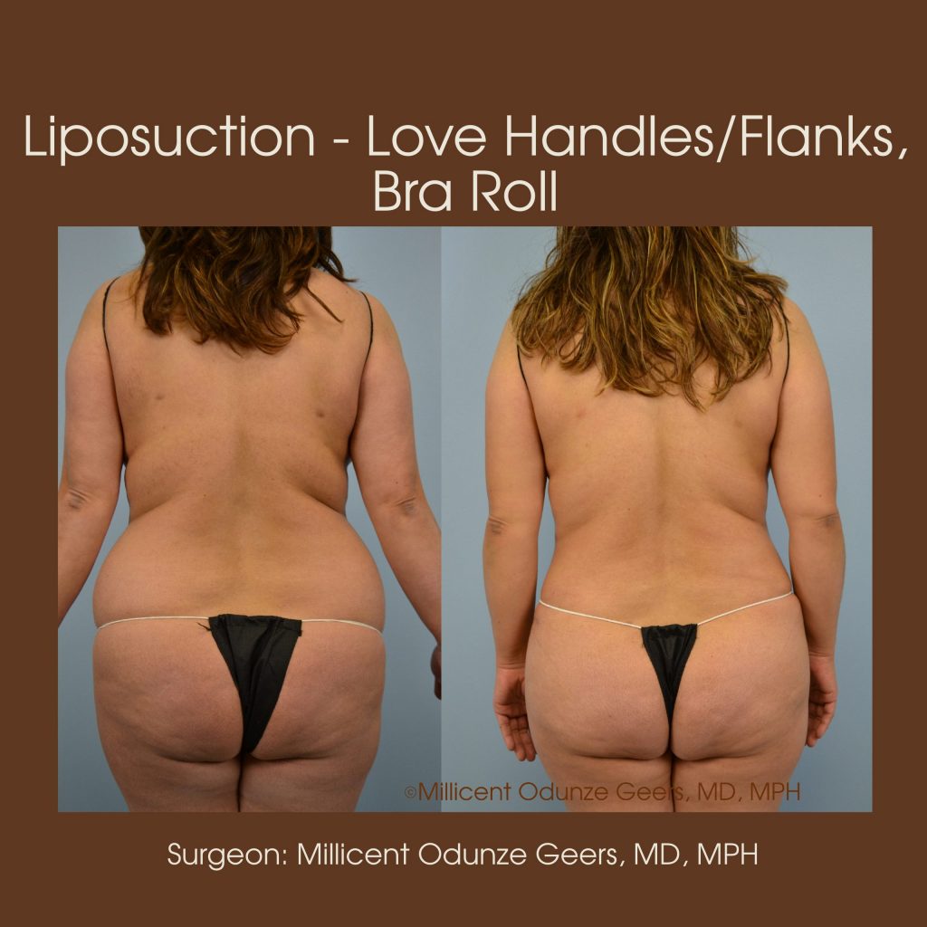 Best Colorado Springs Liposuction of Love Handles, Flanks, Back, Bra Roll