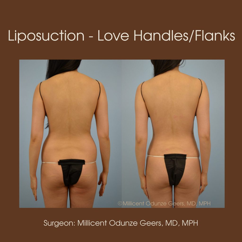 Best Colorado Springs Liposuction of Love Handles/Flanks