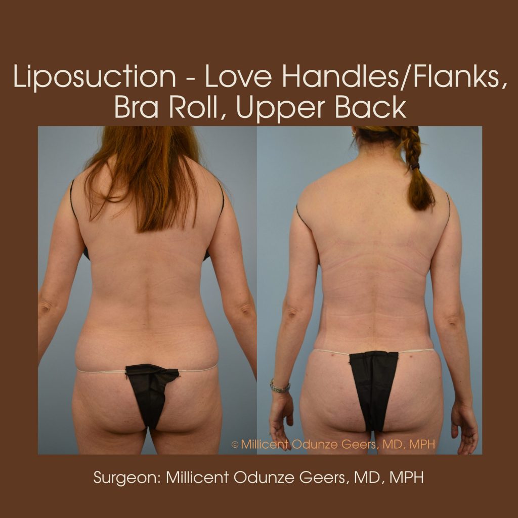 Best Colorado Springs Liposuction of Love Handles, Flanks, Bra Roll, Upper Back