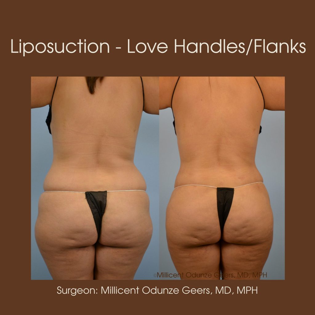 Best Colorado Springs Liposuction of Love Handles, Flanks, Back, Bra Roll