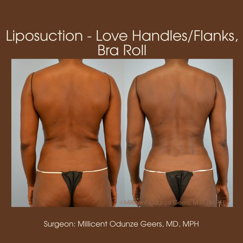 Best Colorado Springs Liposuction of Love Handles, Flanks, Back