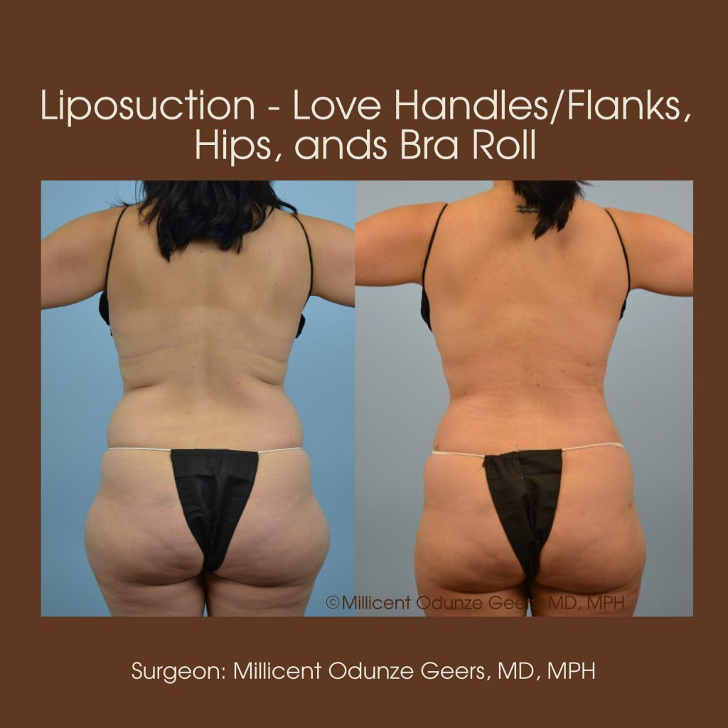 Best Colorado Springs Liposuction of Love Handles, Flanks, Bra Roll