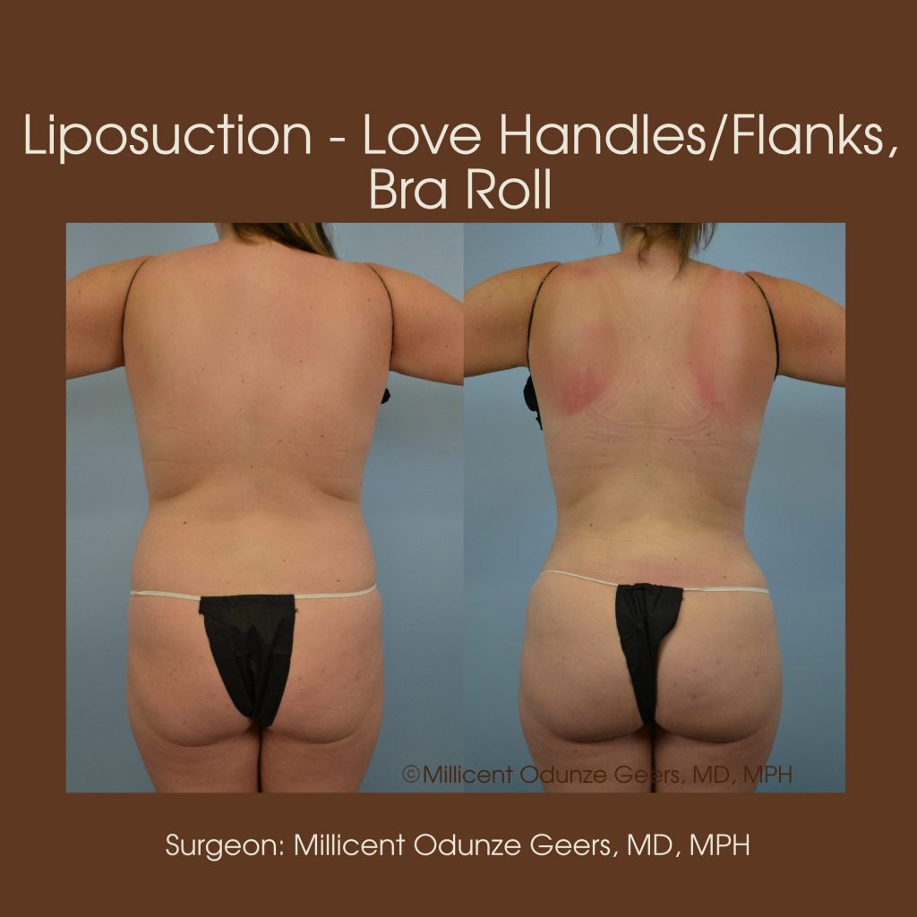 Best Colorado Springs Liposuction of Love Handles, Flanks, Bra Roll