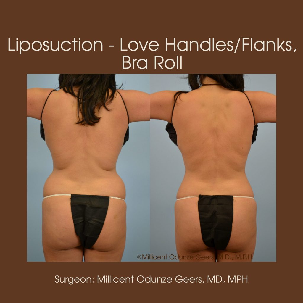 Best Colorado Springs Liposuction of Love Handles, Flanks, Bra Roll