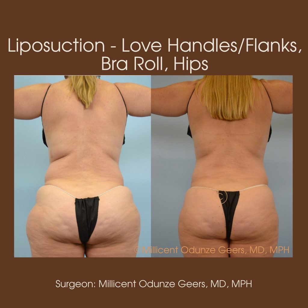 Best Colorado Springs Liposuction of Love Handles, Flanks, Bra Roll, Hips