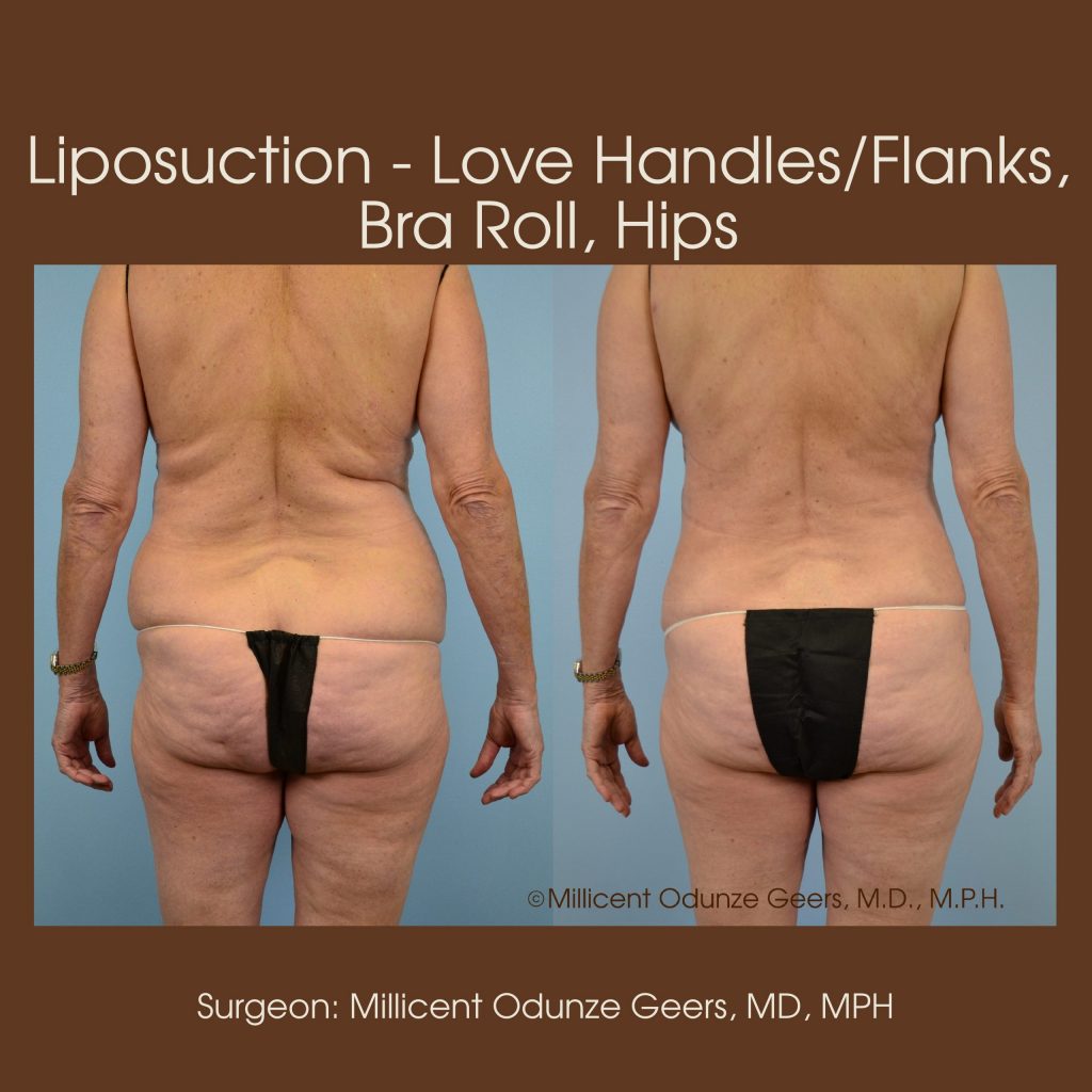 Best Colorado Springs Liposuction of Love Handles, Flanks, Bra Roll