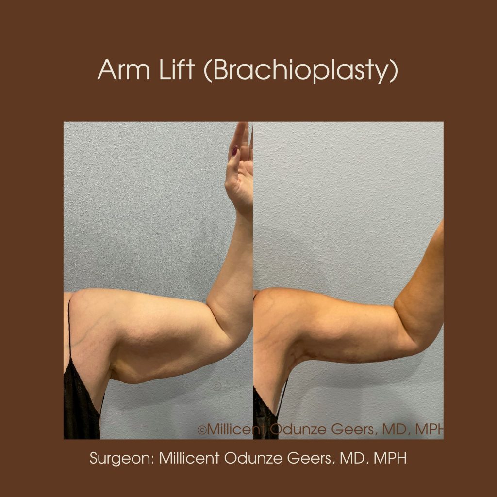 Best Arm Lift Colorado Springs