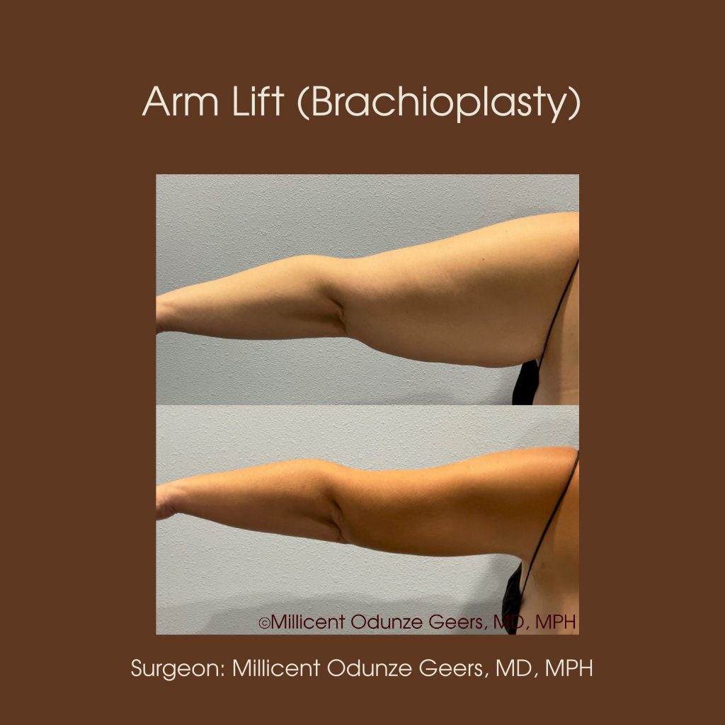 Best Arm Lift Colorado Springs