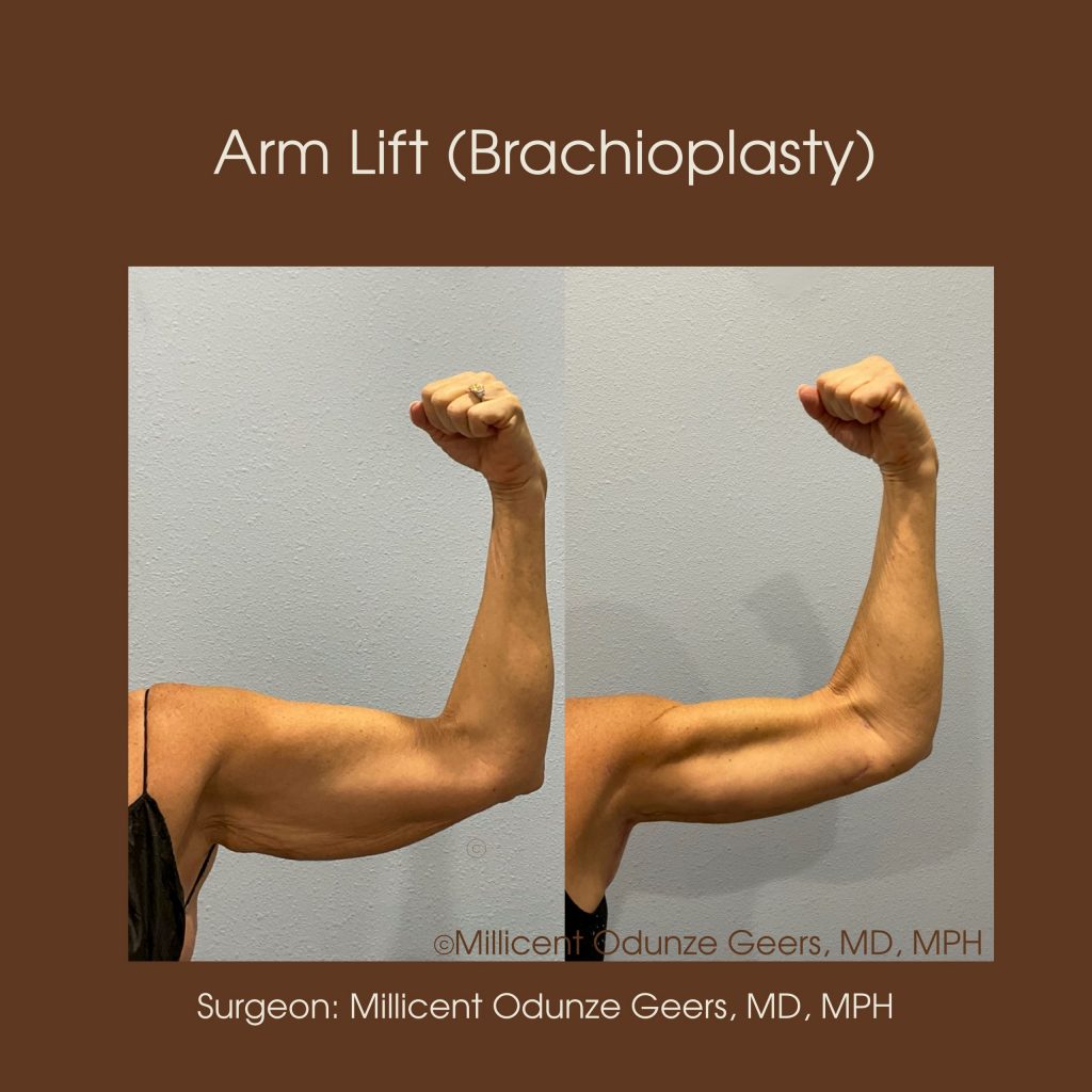 Best Arm Lift Colorado Springs