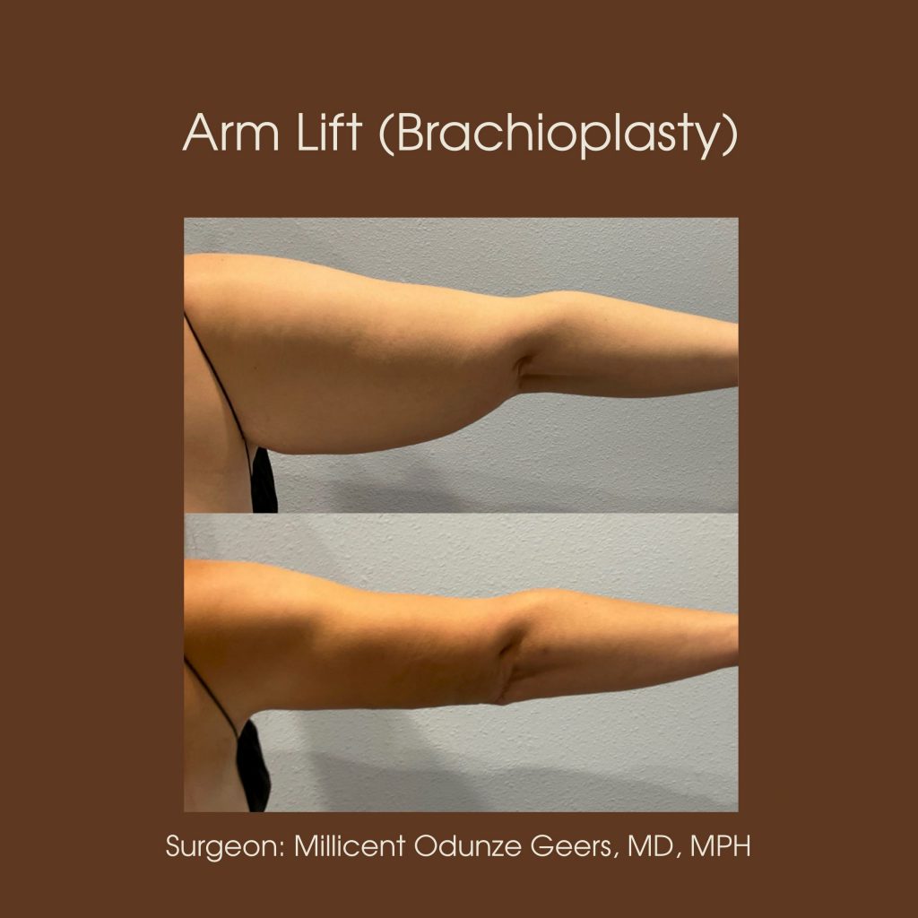 Best Arm Lift Colorado Springs