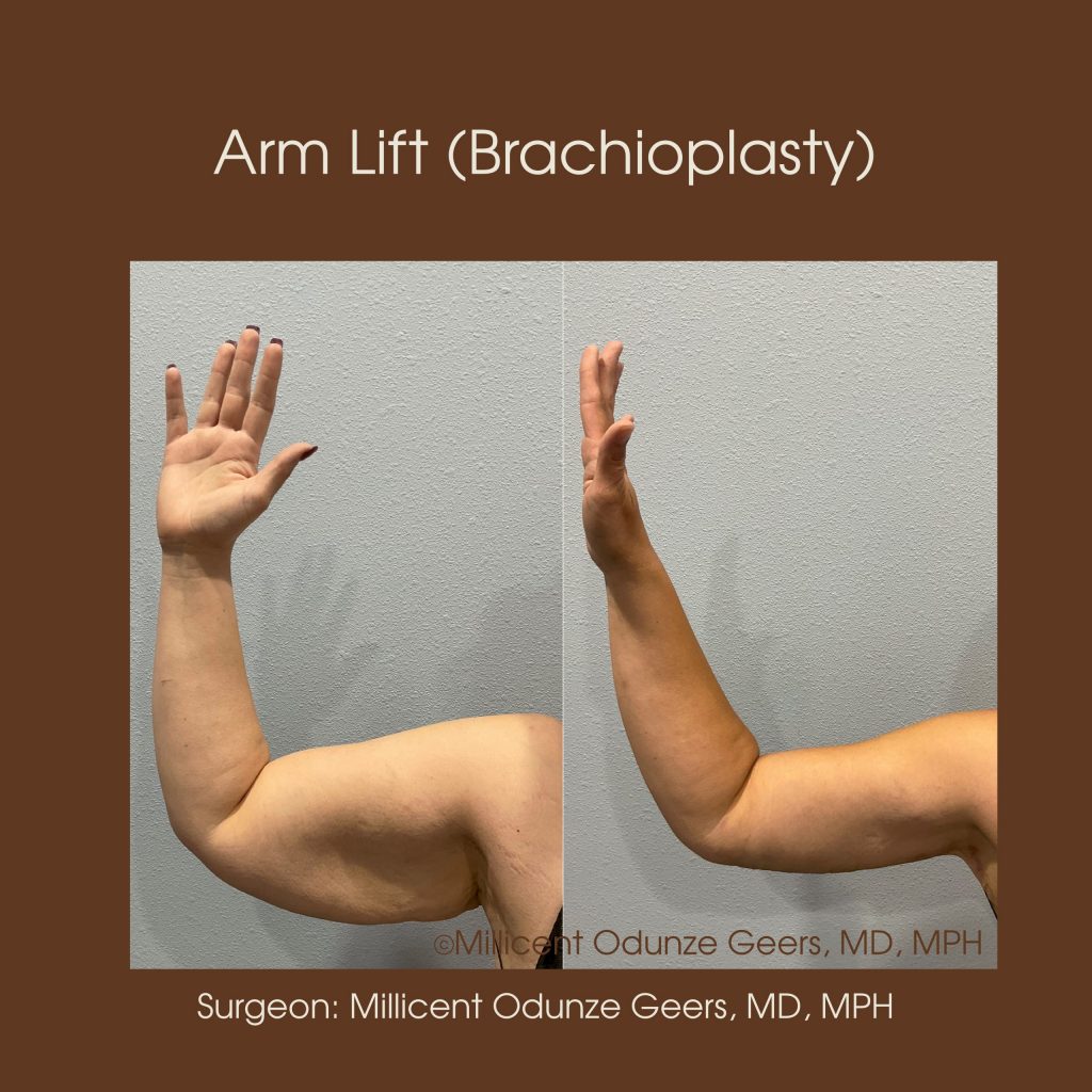 Best Arm Lift Colorado Springs