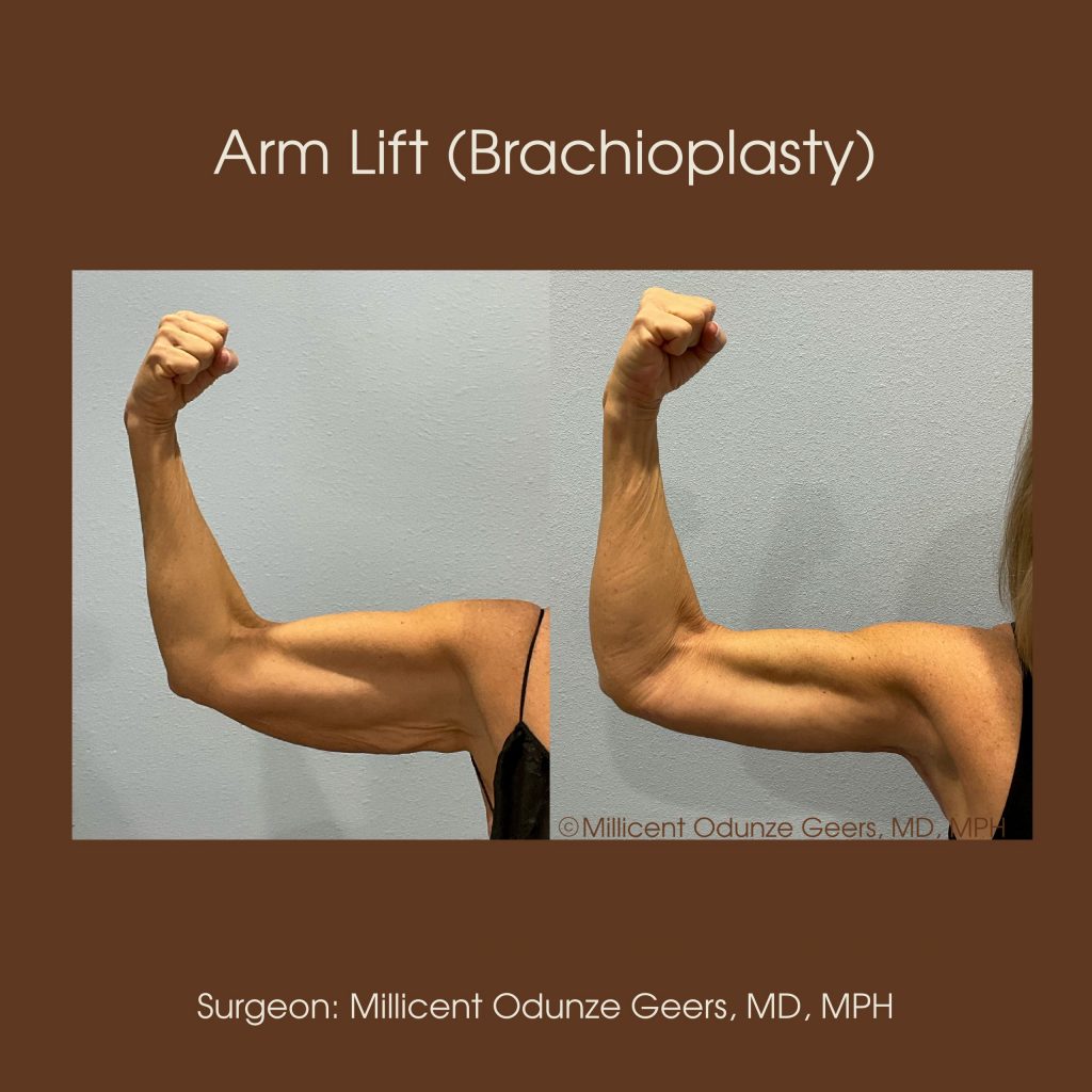 Best Arm Lift Colorado Springs