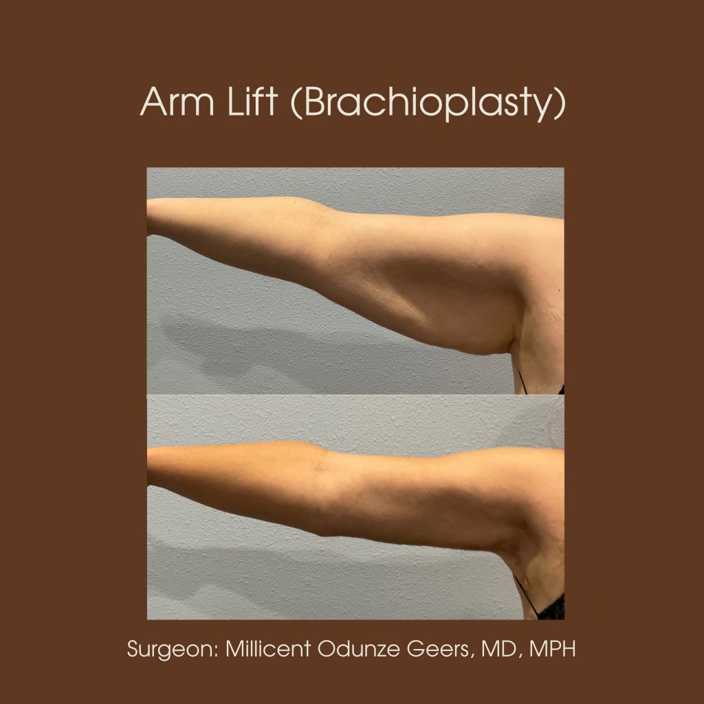 Best Arm Lift Colorado Springs