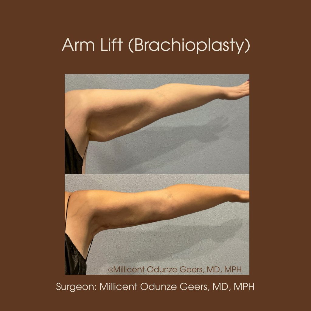 Best Arm Lift Colorado Springs