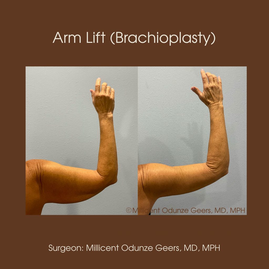 Best Arm Lift Colorado Springs