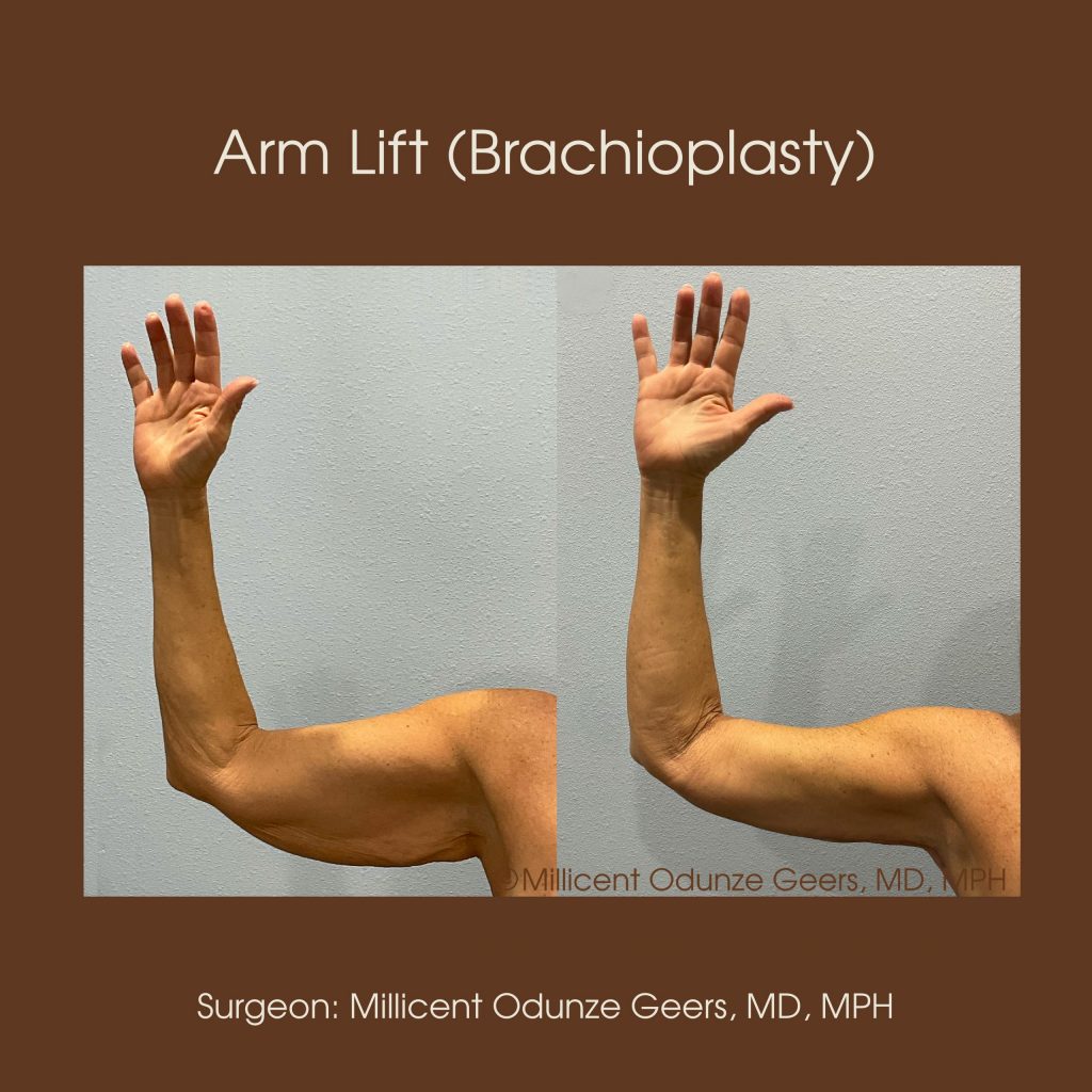 Best Arm Lift Colorado Springs