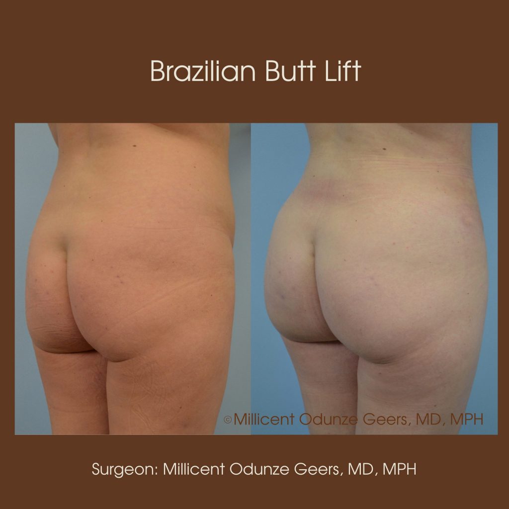 Best Colorado Springs Brazilian Butt Lift