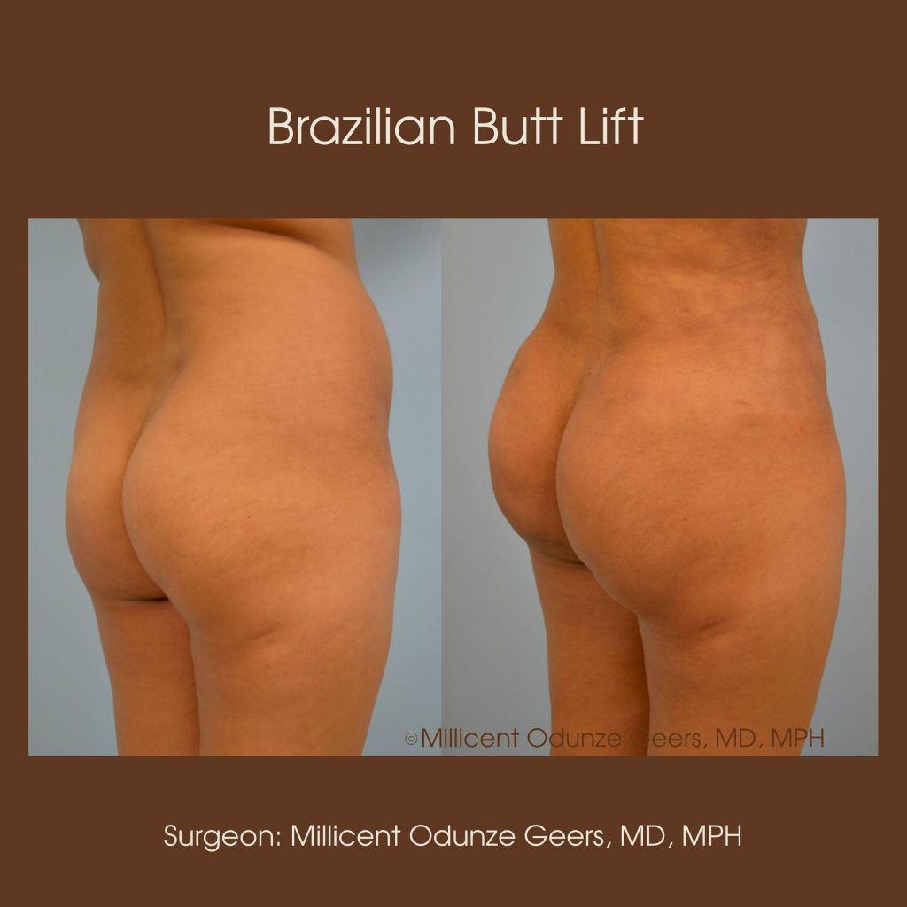 Best Colorado Springs Brazilian Butt Lift