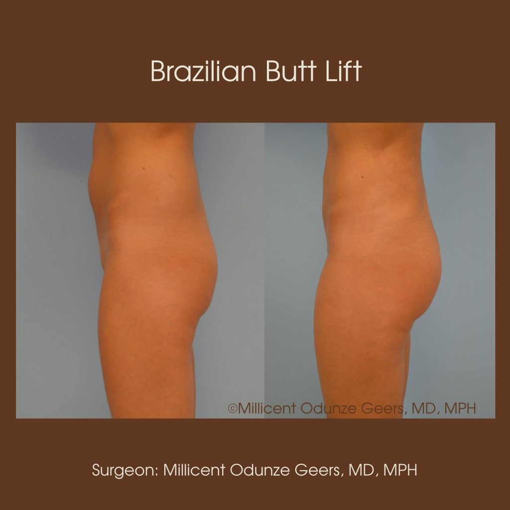 Best Colorado Springs Brazilian Butt Lift