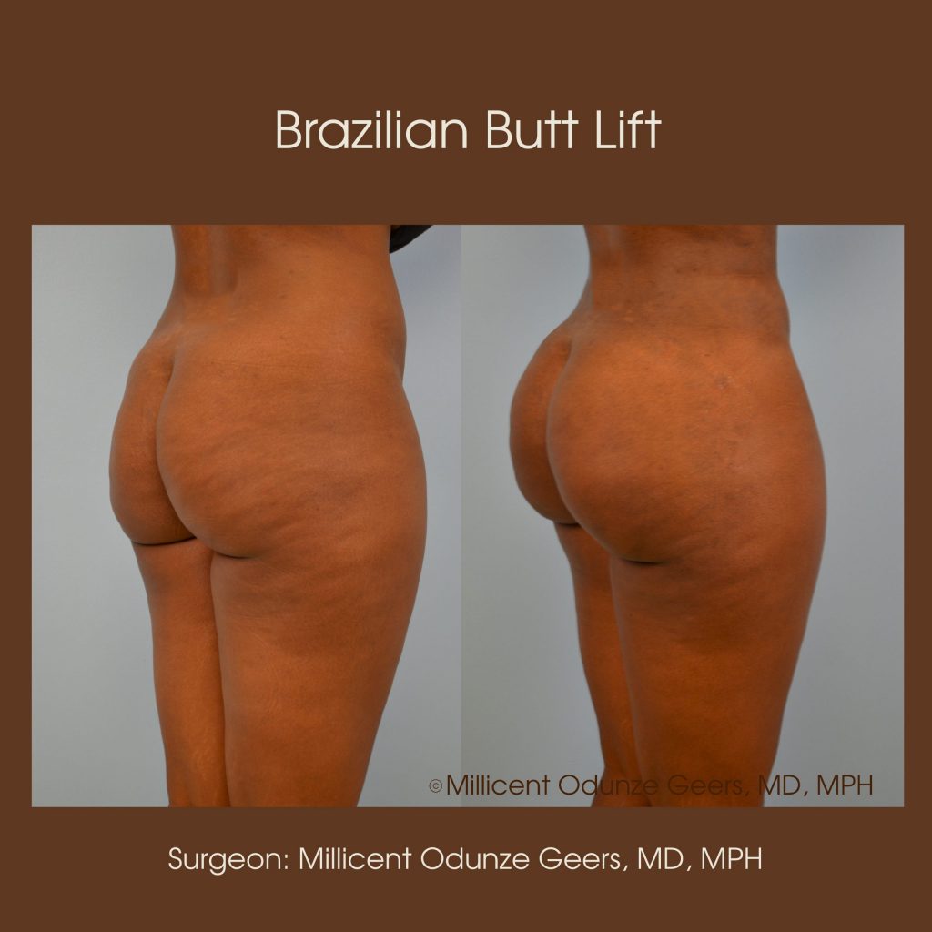 Best Colorado Springs Brazilian Butt Lift