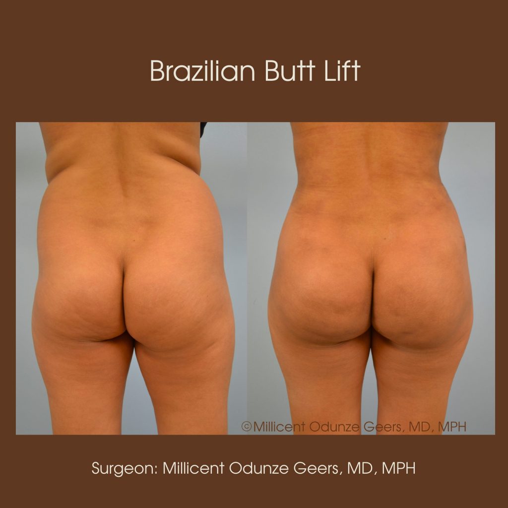 Best Colorado Springs Brazilian Butt Lift