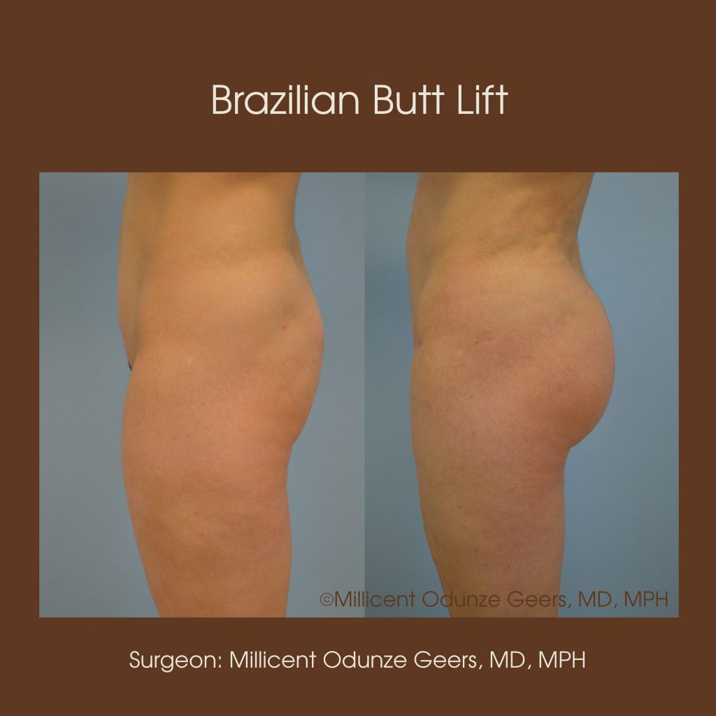 Best Colorado Springs Brazilian Butt Lift