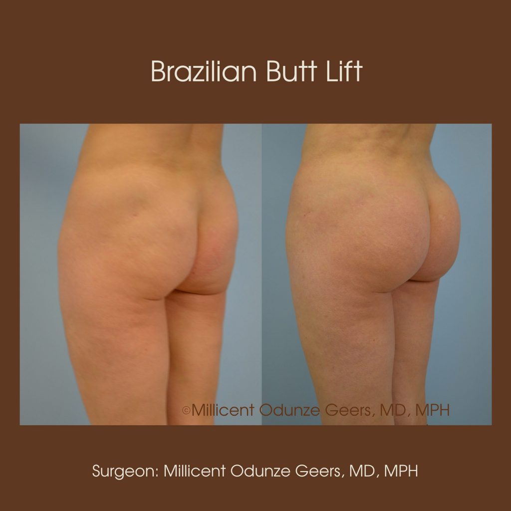 Best Colorado Springs Brazilian Butt Lift