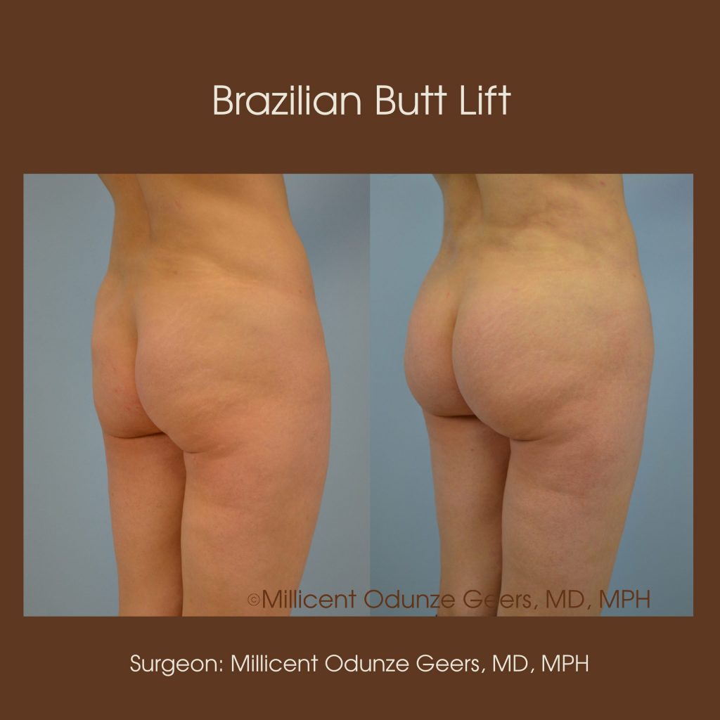 Best Colorado Springs Brazilian Butt Lift