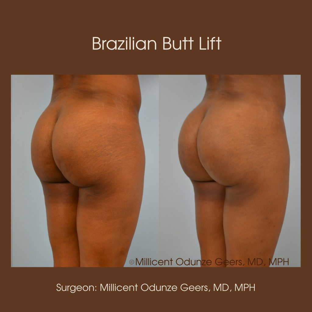 Best Colorado Springs Brazilian Butt Lift