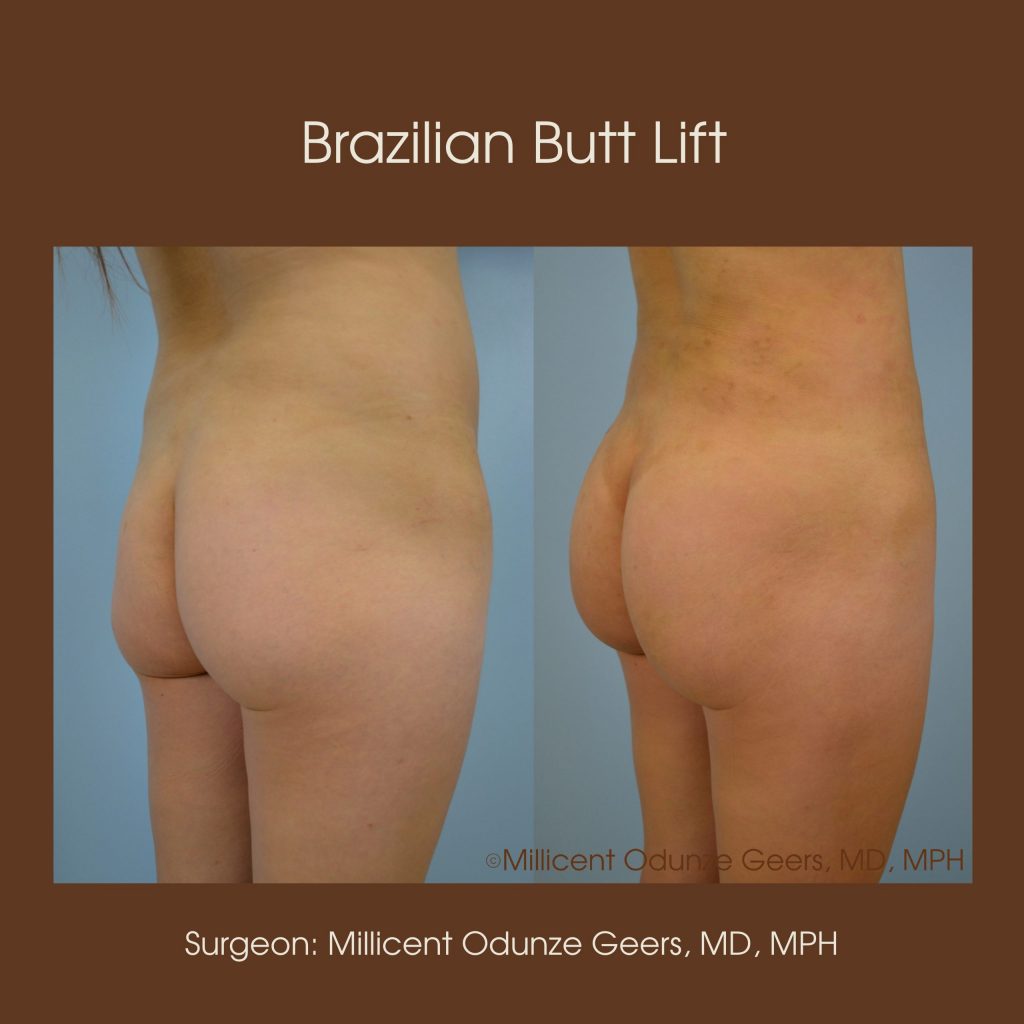 Best Colorado Springs Brazilian Butt Lift