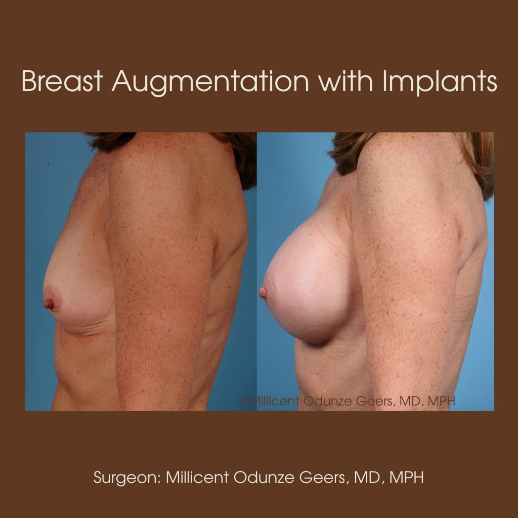 Best Breast Augmentation Colorado Springs