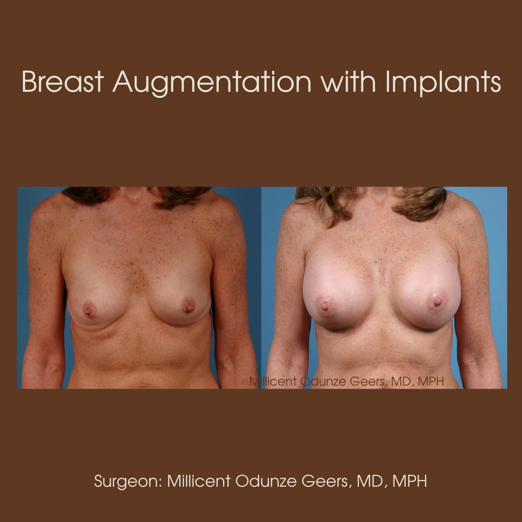 Best Breast Augmentation Colorado Springs