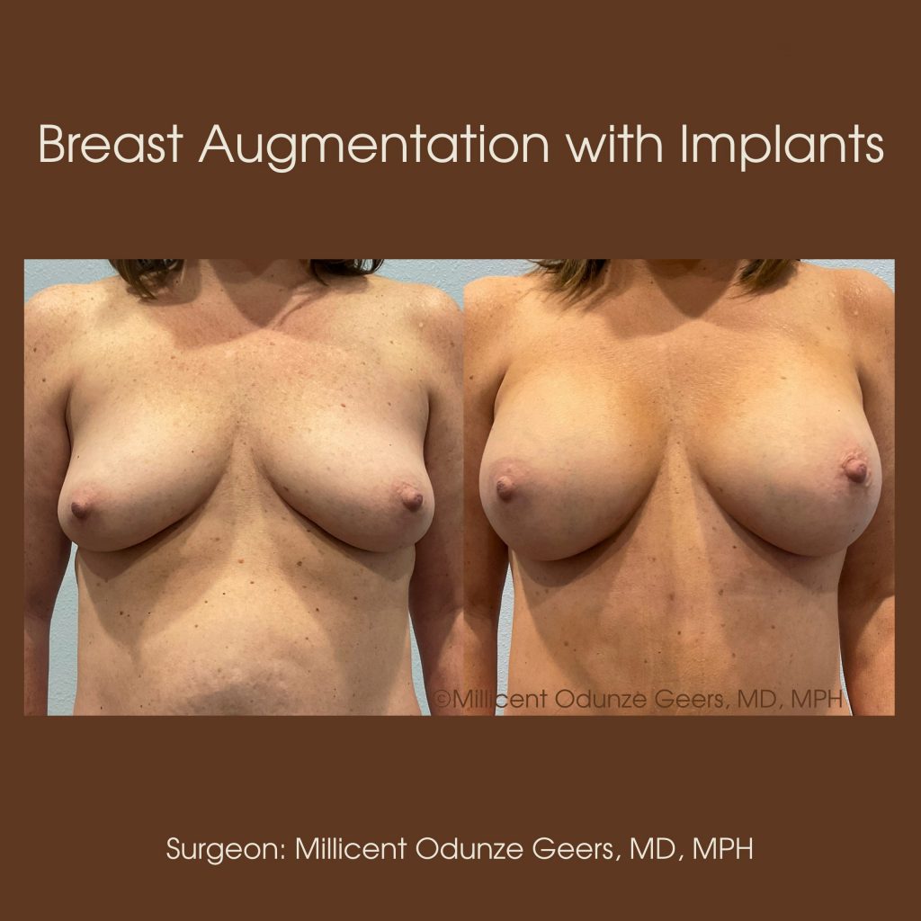 Best Breast Augmentation Colorado Springs