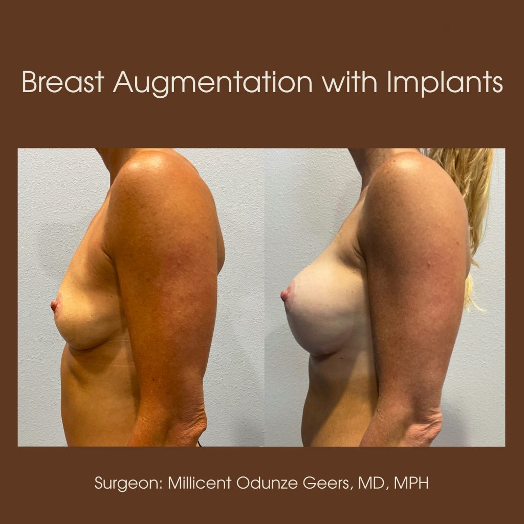 Best Breast Augmentation Colorado Springs