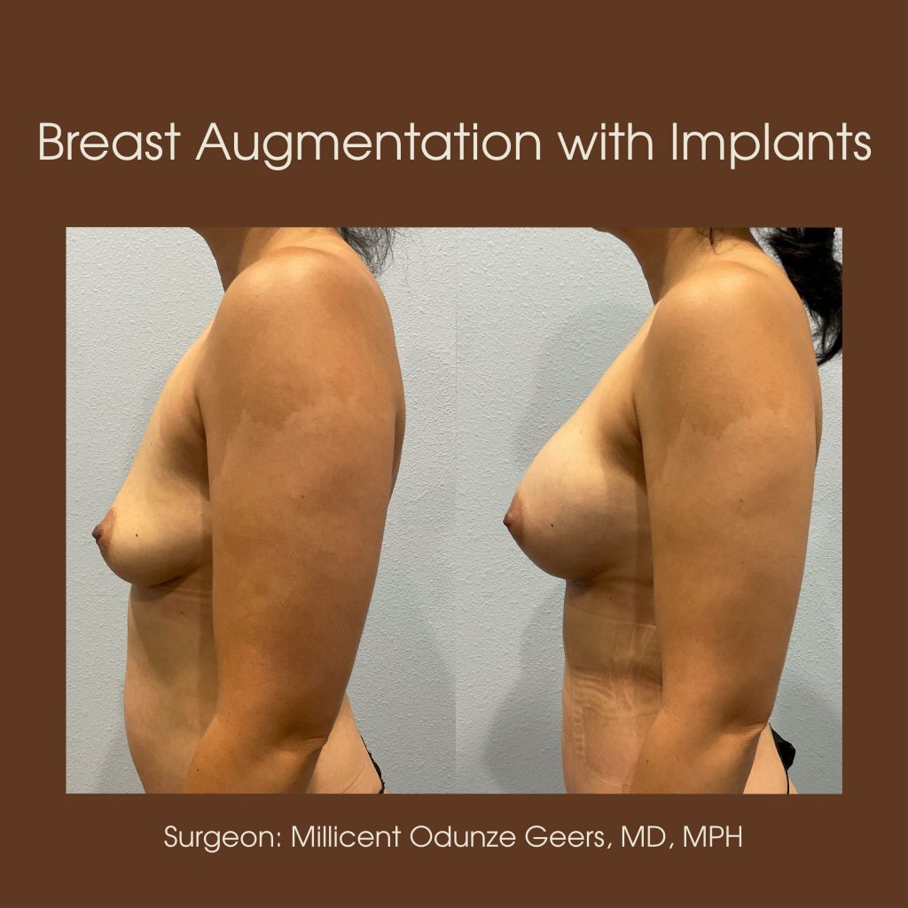 Best Breast Augmentation Colorado Springs