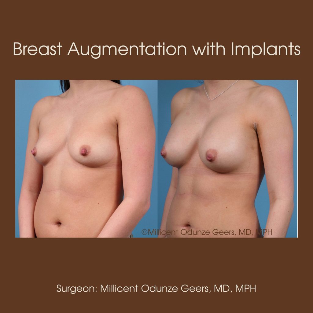 Best Breast Augmentation Colorado Springs