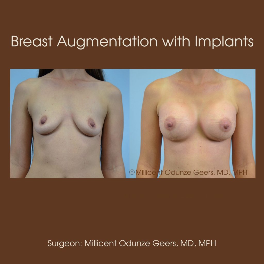 Best Breast Augmentation Colorado Springs