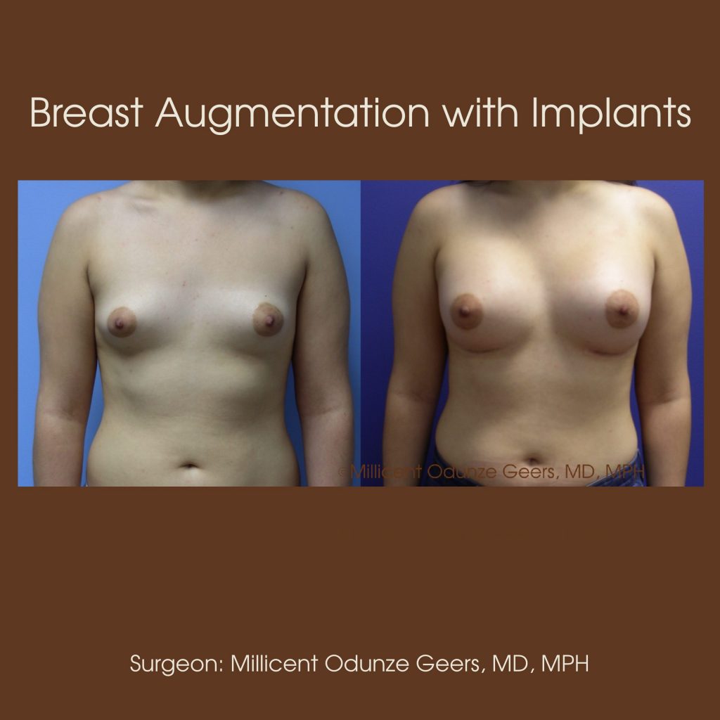 Best Breast Augmentation Colorado Springs