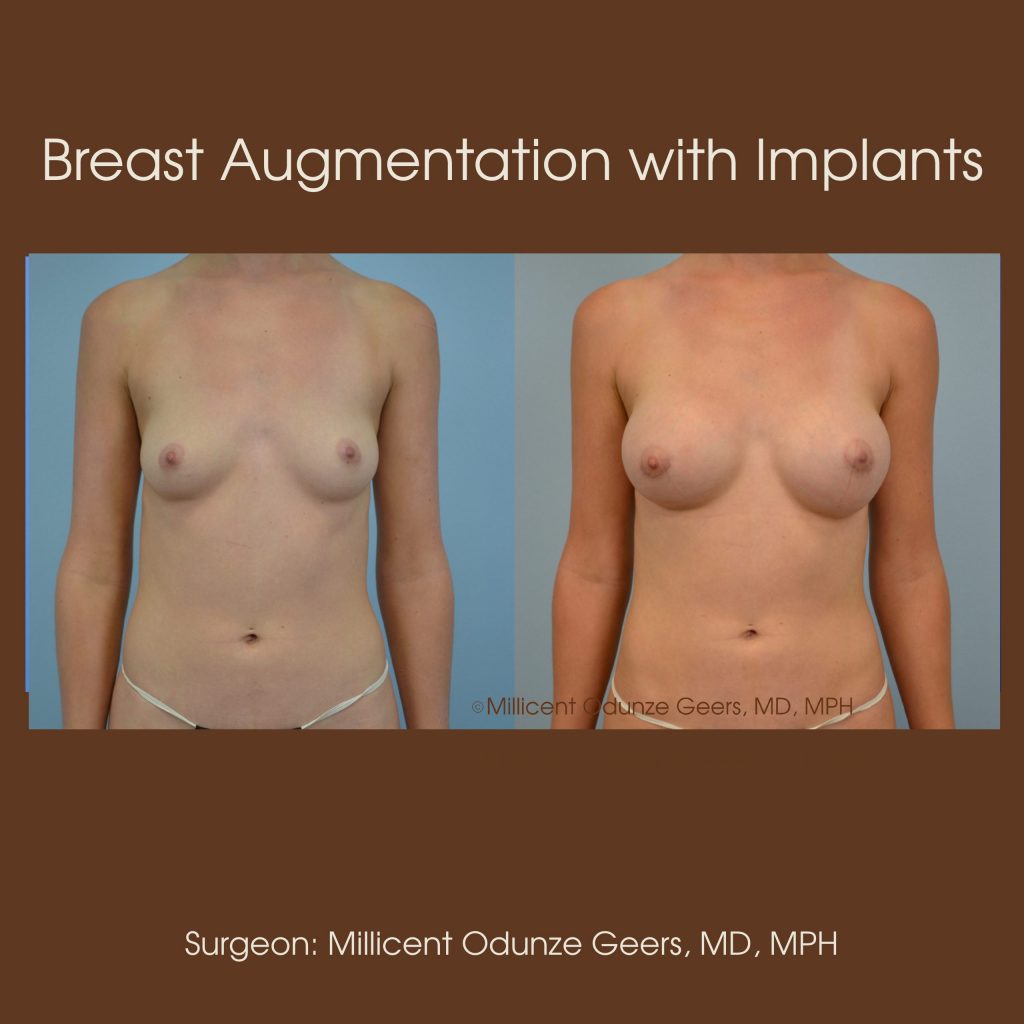 Best Breast Augmentation Colorado Springs