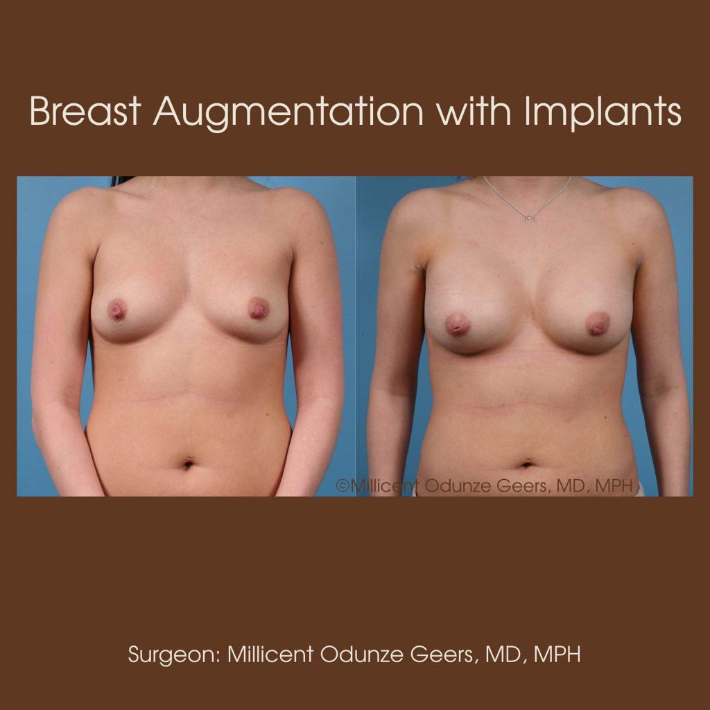 Best Breast Augmentation Colorado Springs