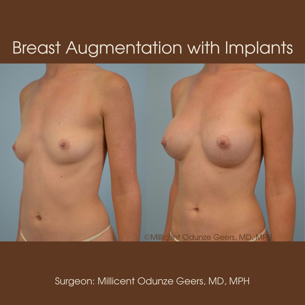 Best Breast Augmentation Colorado Springs